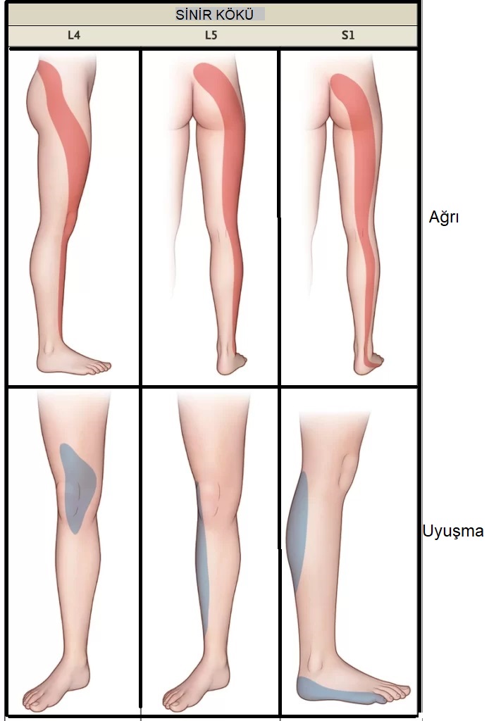 L5–S1 bel fıtığında sinir kökü tutuluma göre ağrı, uyuşma ve kas güçsüzlüğü bölgeleri
