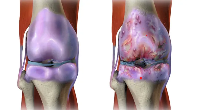 Osteoartrit ve üst sırt ağrısı