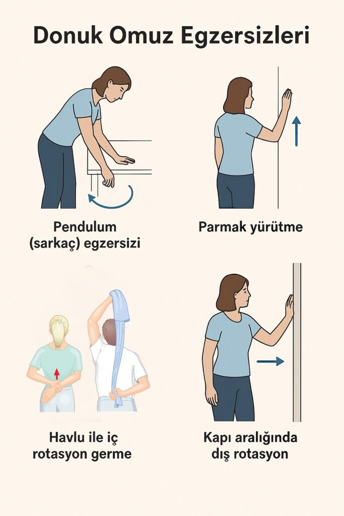 Donuk omuzda fizyoterapi ile birlikte ev egzersizleri çok önemli yer tutar donuk omuz için fizik tedavi ve egzersiz için bazı özel egzerlerin fotoğraflarını içermekte