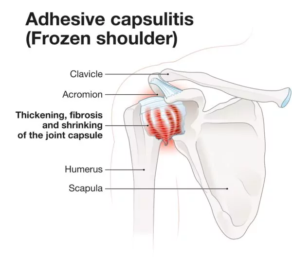 Donuk Omuz (adhesive capsulitis); omuz ekleminde ağrı ile başlayan, zamanla hem aktif hem de pasif hareket açıklığında (ROM) belirgin kısıtlılık ile devam eden bir klinik tablodur.