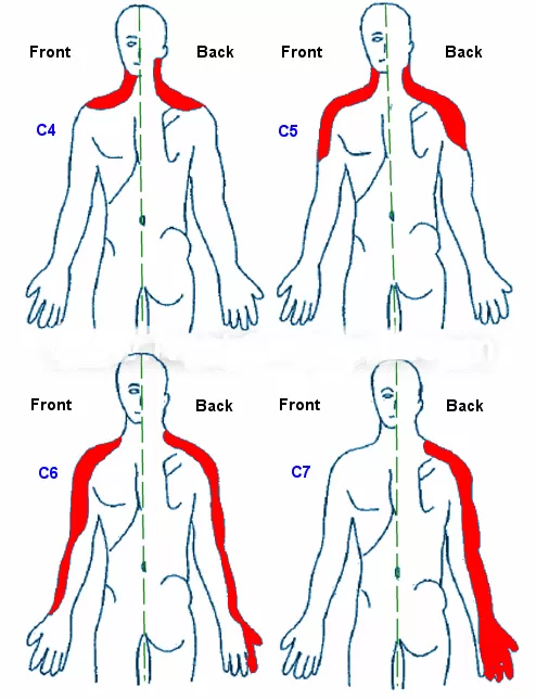 Boyun Fıtığı Belirtileri: Kol Uyuşması, Güç Kaybı ve Tehlike İşaretleri (Fizyoterapist Rehberi)