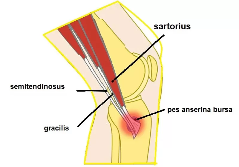 Pes Anserinus Bursiti Ve Medial Diz Ağrısı