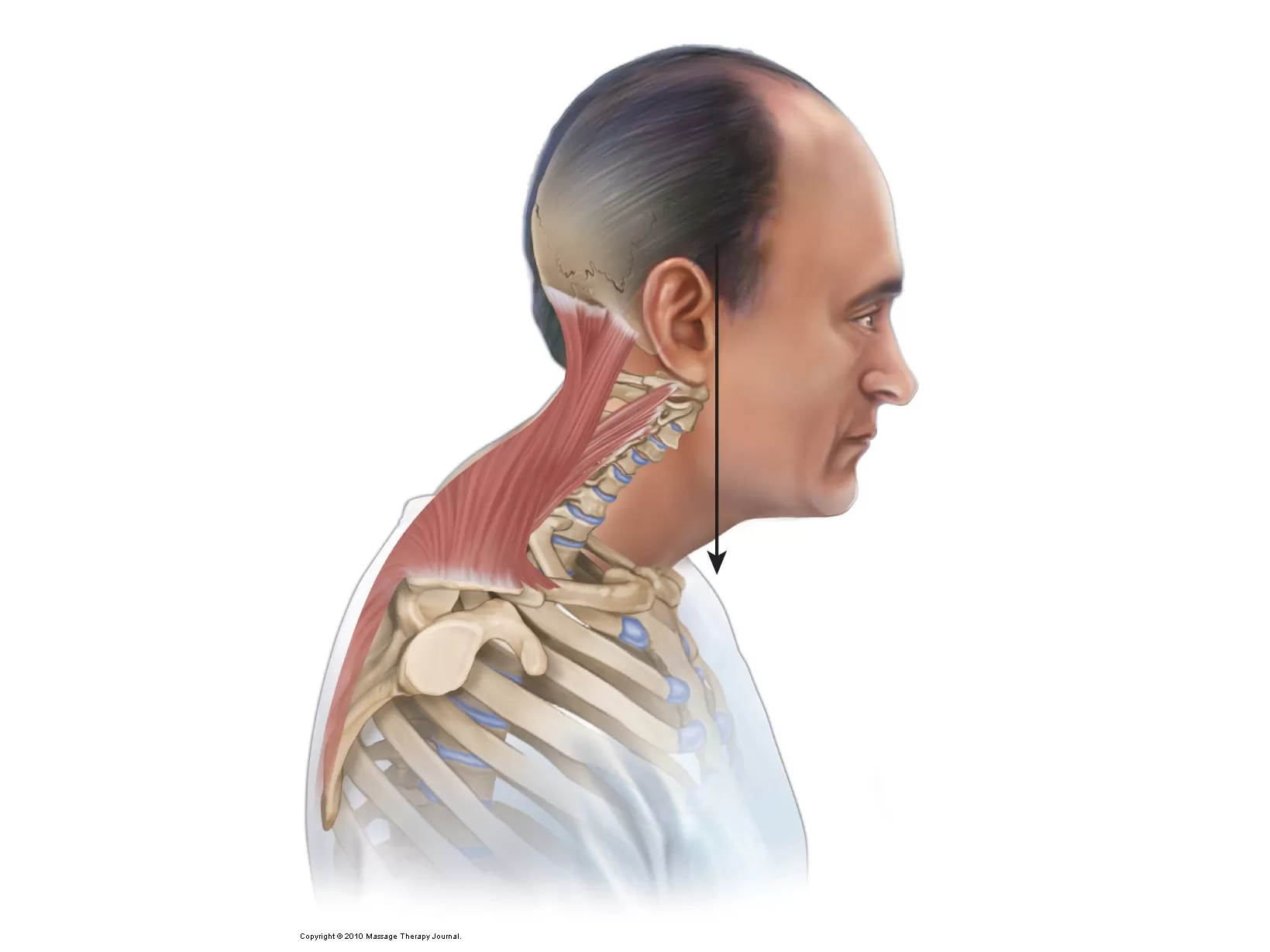 ÜST ÇAPRAZ SENDROMU VE KİFOZ