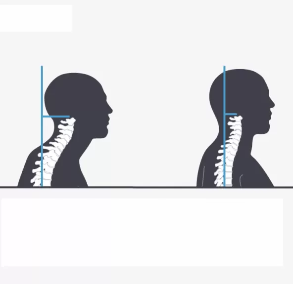 Boyun düzleşmesi belirtileri
