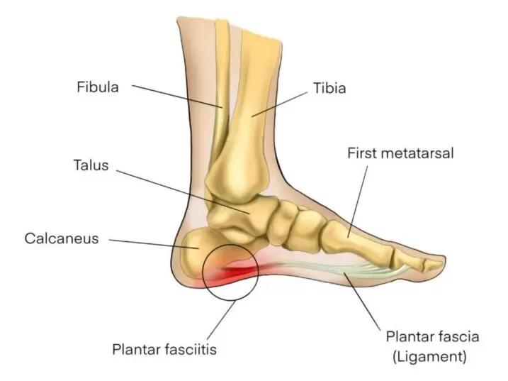 Topuk Ağrısı Sebebi Veya Ayak Topuğu Neden Ağrır ?