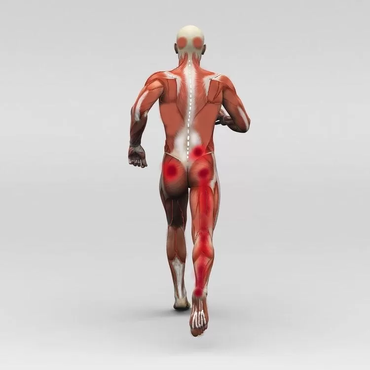 Siyatik Nedir? Ve Belirtileri