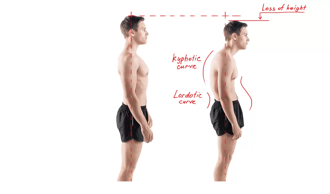 Kifoz (Kamburluk) Tedavisi: Belirtiler, Nedenler ve Etkili Tedavi Yöntemleri