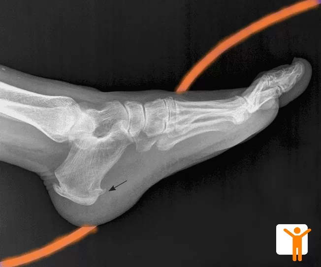 Topuk Dikeni Nedenleri ve Tedavisi